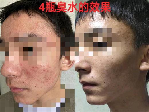 箐源草本臭水成分与功效