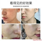 箐源草本臭水真的能祛斑吗